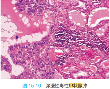 弥漫性毒性甲状腺肿