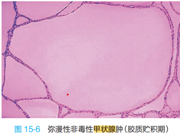 弥漫性非毒性甲状腺肿