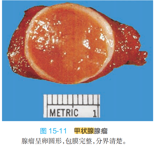 甲状腺肿瘤